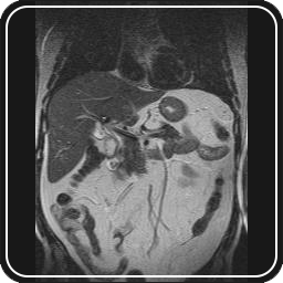 MRI of the sacroiliac joints