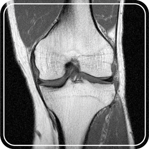 MRI of the knee joint