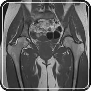 MRI of the hip joints