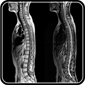 MRI of the spine